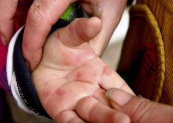 ہاتھ، پاؤں اور منہ کی بیماری عام، گھبرانے کی ضرورت نہیں: ڈاکٹر نثار الحسن