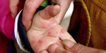 ہاتھ، پاؤں اور منہ کی بیماری عام، گھبرانے کی ضرورت نہیں: ڈاکٹر نثار الحسن